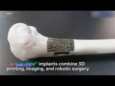 3D printing, Bone, Scaffold, SLS, FDM, Bone sarcoma - YouTube