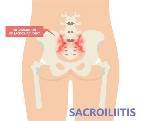 Sacroiliac Joint Injection