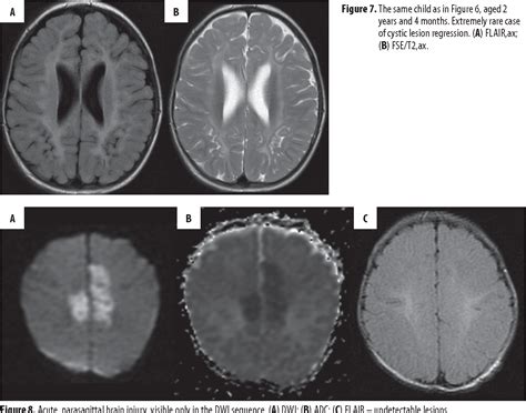 MRI patterns of hypoxic-ischemic brain injury in preterm and full term infants – classical and ...