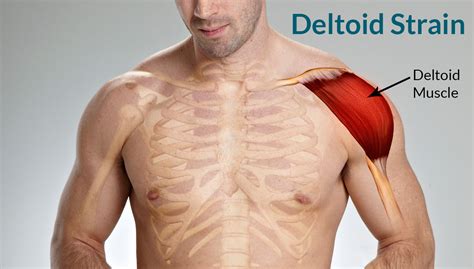 Deltoid Strain: Treatment, Causes, Symptoms, Classification