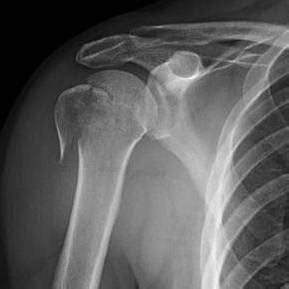 Proximal Humerus Fractures - Trauma - Orthobullets