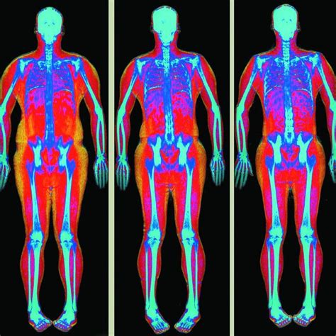 DEXA Scan - Body Analytics