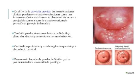 Cervicitis aguda y crónica, ectropion cervical, ulceracion, erosion.