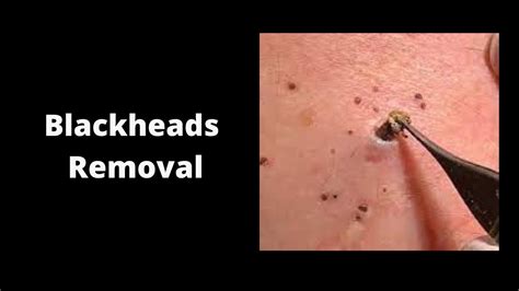 Blackheads Removal & Pimple Popping Videos 2021 - YouTube