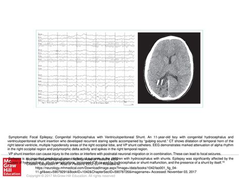 Epilepsy is an important predictor of poor intellectual outcome in the ...