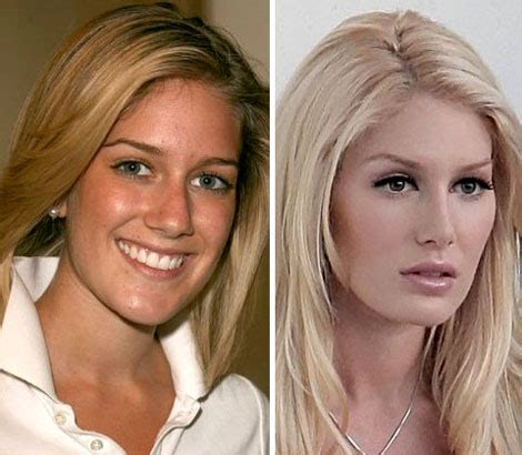 Heidi Montag Before and After Plastic Surgery | Best Plastic Surgeon