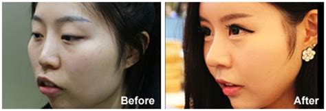 Korean Celebrity Total Face-Line Surgery | Korea Medical Hub(KMH)