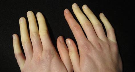 Raynaud's Disease Symptoms ,Causes And Risk Factors