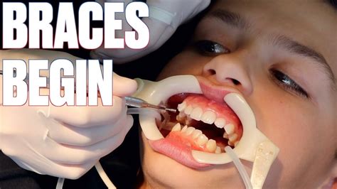 GETTING BRACES FOR THE FIRST TIME | HOW TO SHORTEN TIME WITH BRACES BY SIX MONTHS! - YouTube