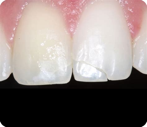 Aesthetic Composite Resin Restorations - Dental Implants