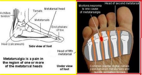 Metatarsalgia or Foot Pain - The Orthobiologic Clinic