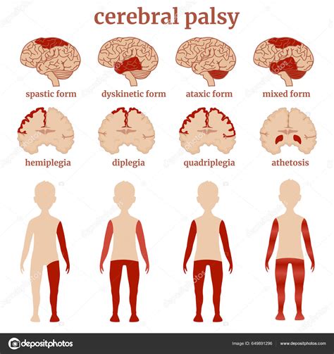 Diagram Indicating Types Cerebral Palsy Using Example Drawings Brain ...