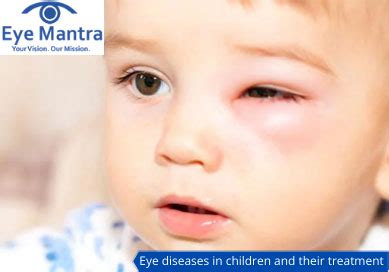 Children’s Eye Diseases- Common Pediatric Eye Problems