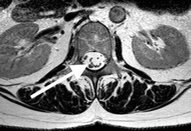 Arachnoiditis | Spinal Arachnoiditis | Dr. Corenman