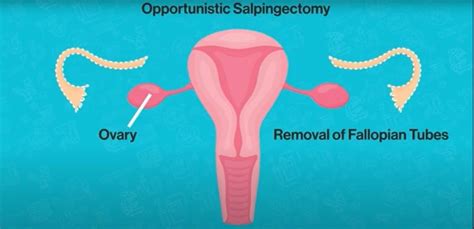 This simple surgery could slash ovarian cancer rates in Canada ...