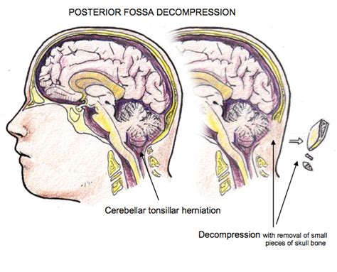 Syndrome Description: Neurological Management and Treatment | M-CM Network