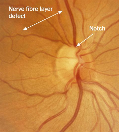 Glaucomatous optic neuropathy: focal enlargement of cup (n… | Flickr