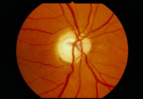 Algorithm Can Identify Retinal Atrophy Cause - Ophthalmology Advisor