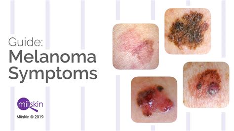 Melanoma Symptoms and Signs: Extensive Guide