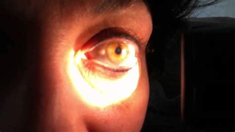 Hippus as a pupillary light response - YouTube