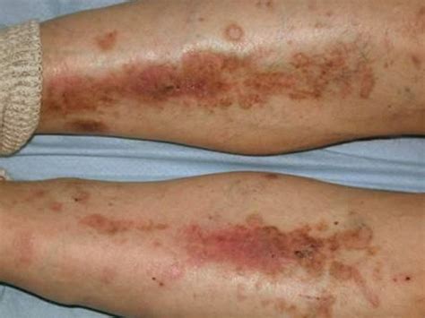 Diabetic dry skin on legs pictures 1 | Symptoms and pictures