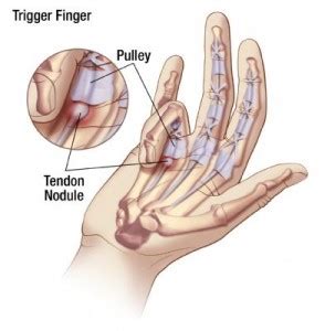 Trigger Finger-Symptoms, Treatment, and Surgical Release - Orthopedic ...