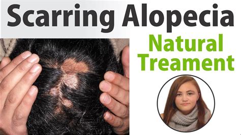 The Best Scarring Alopecia Natural Treatment in USA at Alopecia Treatment Center - YouTube