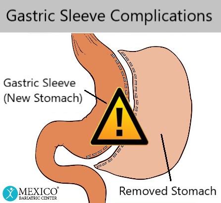 Gastric Sleeve Mexico Complications, Risks - Comprehensive Guide