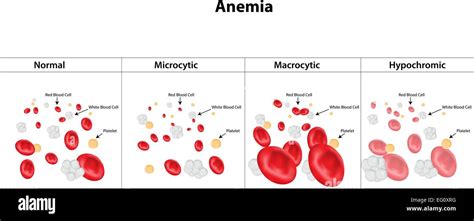 Types of Anemia Stock Vector Image & Art - Alamy