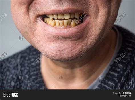 Yellow Rotten Teeth Image & Photo (Free Trial) | Bigstock