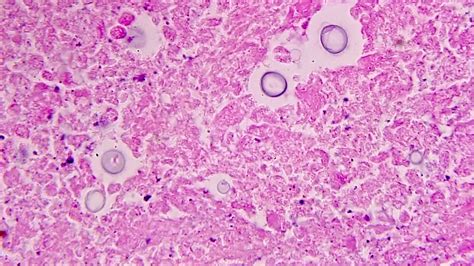 Pathology Outlines - Cryptococcus neoformans & gattii