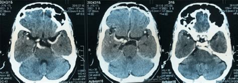 Contrast CT showing vertebrobasilar dolichoectasia | Download Scientific Diagram