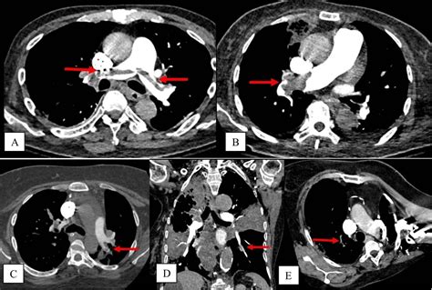 Diagnostic Yield of CT Pulmonary Angiogram in the Diagnosis of Pulmonary Embolism and Its ...