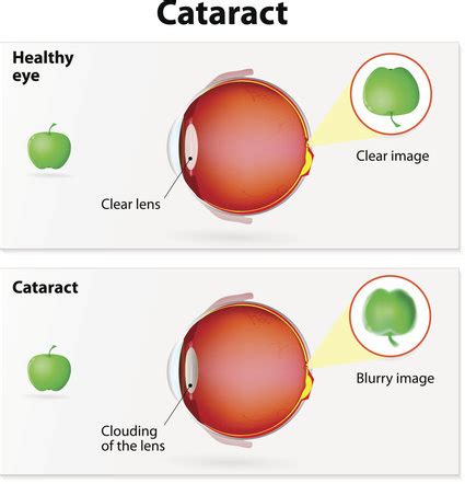 How Long is Recovery After Cataract Surgery? | Anne Arundel Eye Center