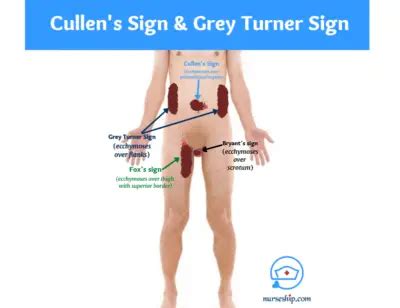 Grey Turner Sign |Causes |Nursing Considerations - Nurseship.com