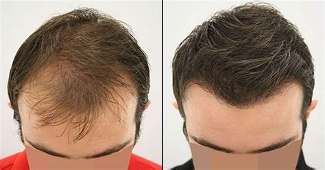 Hair Transplant Turkey Before and After Photos 2023 | AEK Hair Clinic