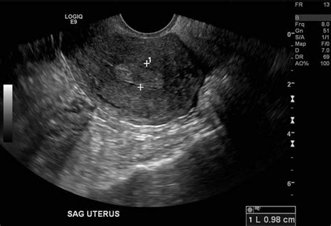 [36+] Uterine Cancer Ultrasound Endometrial Hyperplasia