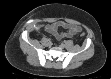 Colocutaneous fistula | Radiology Case | Radiopaedia.org