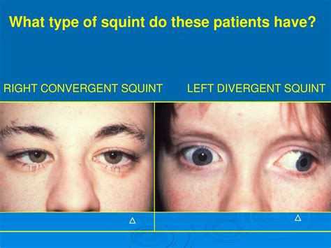 PPT - An Overview of the Orthoptist Practical Demonstration PowerPoint Presentation - ID:3337070