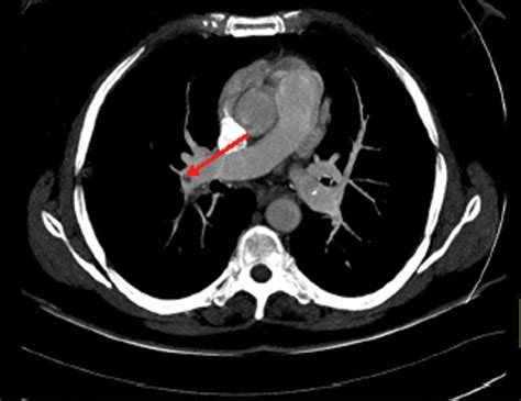 Pulmonary Embolism Masquerading as High Altitude Pulmonary Edema at High Altitude | High ...