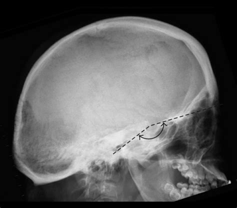 Platybasia: a flat cranial base as a consequence of a f | Open-i