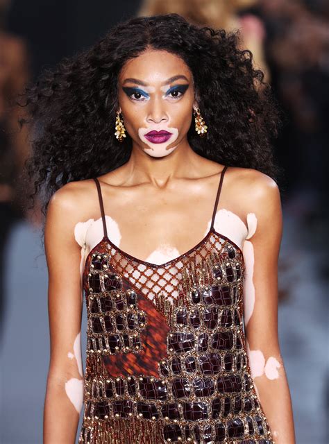 Why These New Dolls With Vitiligo Are So Important | Winnie harlow, La fashion week, Fashion