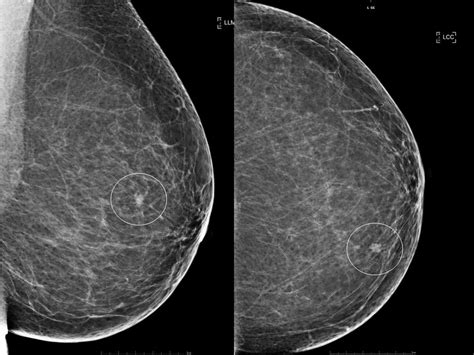 Plain x-ray mammograms demonstrating a small spiculated mass (circled)... | Download Scientific ...