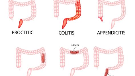 Ulcerative colitis - Colon Ulcer - Ulcer Choices