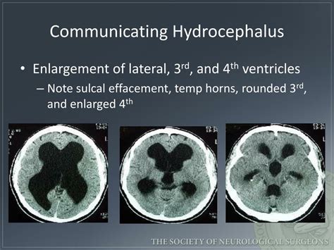 PPT - Emergency Evaluation of Hydrocephalus Shunt Patients PowerPoint Presentation - ID:2079100