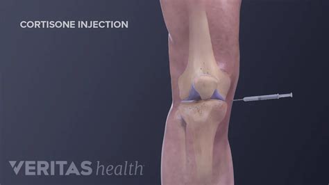 How Long Does A Prednisone Shot Last: Duration And Effects Explained