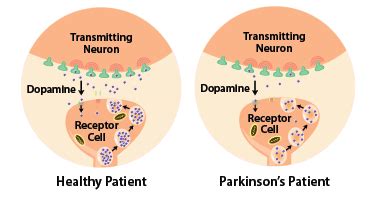 Understanding Parkinson's Disease | Brain Institute | OHSU