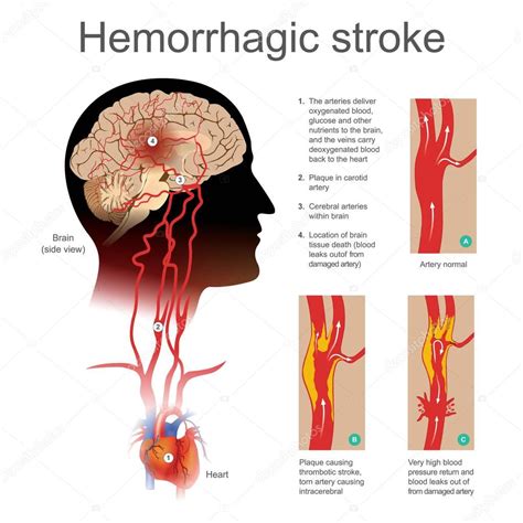 Hemorrhagic stroke. Plaque causing thrombotic stroke torn artery ...