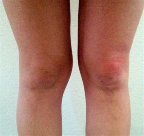 Jennifer's Cancer Journey: Knee photos