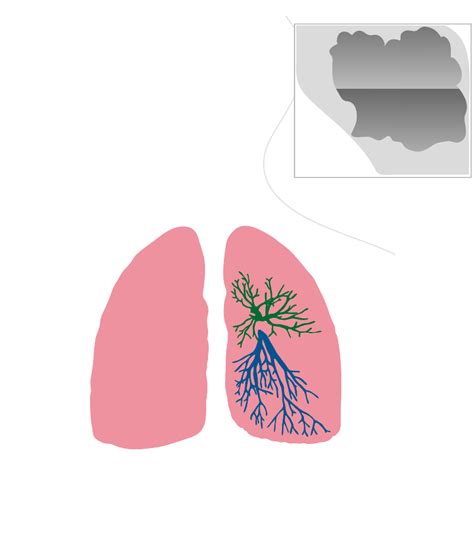 Microbial Diseases of the Respiratory System | Boundless Microbiology